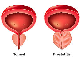 Image result for Overflow Incontinence