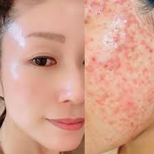 サロンケアで肌が荒れた⁈』 安心してください🪄 それはあなたの本来持っている肌ポテンシャルを 最大限に引き出しているサインです🫧  「あなた史上最高のお肌へ」 導くお手伝いをさせてください💆‍♀️✨ #美肌 #艶肌 #アンチエイジング効果 #エイジングケア #スキンケア ...