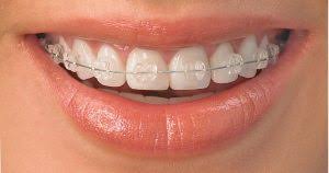 Ini adalah video perbedaan karet behel yang satuan dan panjang, power o dan power chain pada gigi pakai behel, perbedaannya ada pada kegunaannya temen2. Layanan Orthodontic Orthodonti Behel Kawat Gigi Dianov Dental Care