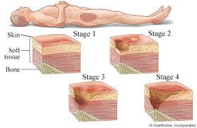 stages of pressure injuries