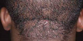 While ingrown hairs more commonly occur in individuals with curly hair, almost everybody will develop one at some point in their life. How To Get Rid Of Ingrown Hair Hubnaija
