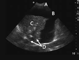 When you have a pleural effusion, fluid builds up in the space between the layers of your pleura. Pleural Procedures And Thoracic Ultrasound British Thoracic Society Pleural Disease Guideline 2010 Thorax