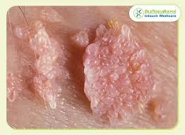 Image result for genital warts
