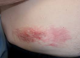 Contact Dermatitis Devices Implants Dermatology Advisor