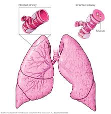 This test can tell a doctor how much inflammation is in your airways by measuring the amount of nitric oxide. Asthma Symptoms And Causes Mayo Clinic