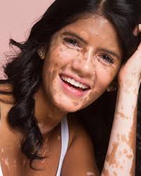 Skin Deep: Sonya Charles and her journey to self love with vitiligo