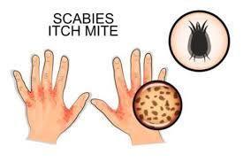 Scabies Is A Highly Contagious Skin Disease Caused By A Parasitic Mite Called Sarcoptes Scabiei It Spreads From Dire Scabies Scabies Treatment Mites On Humans
