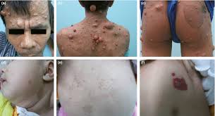 Neurofibromatosis is a genetic disease caused by a mutation in a gene responsible for a protein that regulates nerve tissue growth, and can be inherited. Clinical Manifestations Of Patients With Neurofibromatosis Type 1 In Download Scientific Diagram