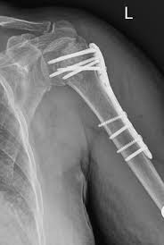 Omuz Kirigi Ameliyati Op Dr Taner Bekmezci