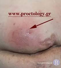 Image result for Perianal Abscess