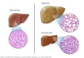 Mayo clinic health letter 200 first st. Liver Problems Symptoms And Causes Mayo Clinic