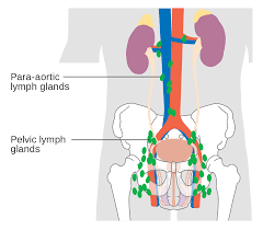 Whenever the lymph nodes become inflamed, a biopsy can be performed. File Diagram Showing The Pelvic And Para Aortic Lymph Nodes Cruk 339 Svg Wikimedia Commons