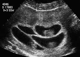 During pregnancy, the amount of blood in your body increases, and even more so when carrying twins versus just one baby. Multiple Pregnancy Radiology Key