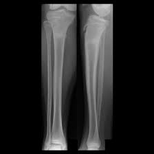 Image result for Tibia Stress Fracture