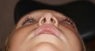 They're not usually serious, but they can keep growing and block your nose if not treated. Orbital Cellulitis In A Child Eyerounds Org Ophthalmology The University Of Iowa