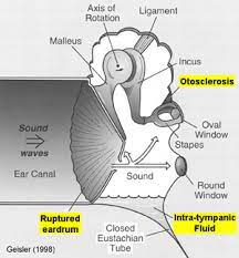 Check spelling or type a new query. Conductive Hearing Loss