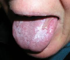 Image result for lichen planus on tongue)