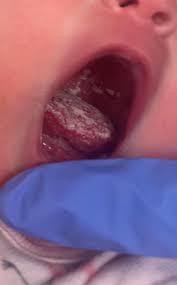 Image result for Oral thrush roof of mouth