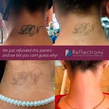 How does laser tattoo removal work? Remove That Mistake In Half The Time With This New Innovation In Tattoo Removal