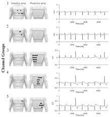Image result for QRS Complex