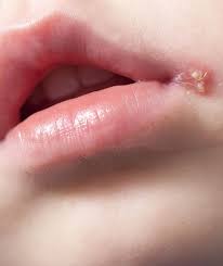 Küssen ist in dieser zeit verboten, denn die viren sind hoch ansteckend. Herpes Bei Kindern Und Babys Lippenherpes Ratgeber