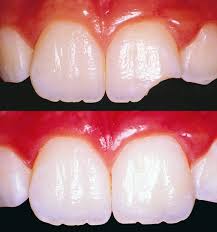 Dental Tooth Color Fillings And Bonding Doctor Specialist
