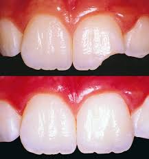 dental tooth color fillings and bonding doctor specialist