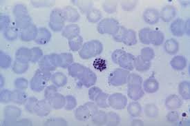 Thin and thick giemsa stain. Staining Methods For Malarial Blood Films Compared Microbiology Mobile Labmedica Com