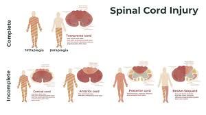 Image result for Spinal Trauma