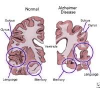 Is it alzheimer's or just old age? Alzheimer S Disease Definition Symptoms Causes Treatments Stages