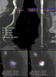 Your health is more important than anything else. Associations Between Coronary Artery Stenosis Detected By Coronary Computed Tomography Angiography And The Characteristics Of Health Checkup Examinees In The Republic Of Korea Radiography