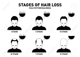 The catagen phase is a transitional time that lasts. Hair Loss Stages And Types Of Male Hair Loss Male Pattern Baldness Royalty Free Cliparts Vectors And Stock Illustration Image 103240064