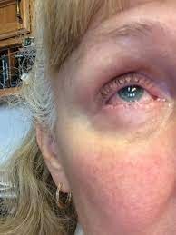 Pin On Nickel Allergies