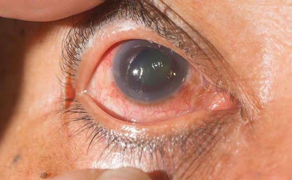 Blurry Vision Diagnosis