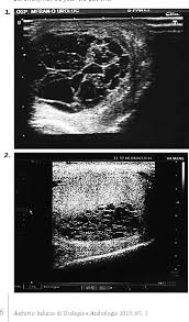 Tubular ectasia of rete testis (rare plural: Figure 1 From Tubular Ectasia Of The Rete Testis Tert Differential Diagnosis Of Cystic Testicular Disorders Semantic Scholar