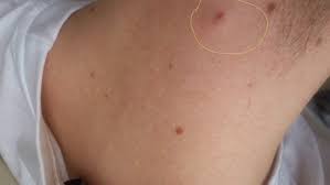 Inflammatory breast cancer is an infrequent, aggressive type of breast cancer that spreads rapidly. Is Dimpling A Sign Of Breast Cancer This Woman Posted A Photo Of Her Breast Cancer As A While Not Always Indicative Of Breast Cancer A Dimple Is Subtle