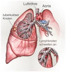 Lungenschmerzen Symtom Anzeichen Ursachen Diagnose Behandlung Krank De