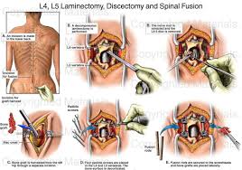 Back Surgery L4 L5 Lumbar Laminectomy L4 5 Discectomy Diskectomy And Spinal Fusion With Pedicle Screws Spinal Fusion Spinal Fusion Surgery Spinal Surgery