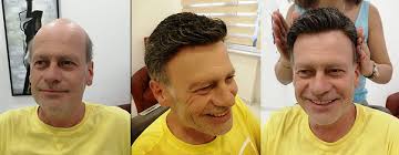 Alopecia synonyms, alopecia pronunciation, alopecia translation, english dictionary definition of alopecia. What Is Prosthetic Hair Hairhotel