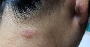 Image result for Tinea Capitis