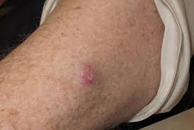 Image result for Merkel Cell Carcinoma