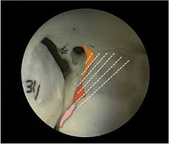 The warning signs of hypothyroidism also mimic other common health conditions, and are often dismissed because a patient is overweight or obese. Augmented Endoscopic Orbital Apex Decompression In Dysthyroid Optic Neuropathy Eye