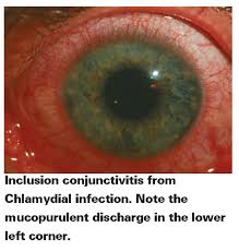 Image result for Gonococcal Conjunctivitis