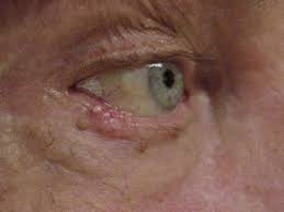 Because it is often caused by exposure to the sun, skin cancer is one of the most common cancers in the world. Eyelid Tumor Surgery Nashville Sherman Aesthetic Center Sherman Aesthetic Center