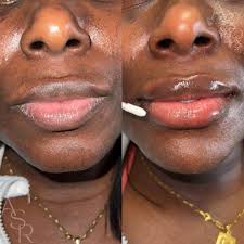 FACIAL BALANCING] ➕chin and lip combo treatments are my favorite ➕1 syringe  of RHA 4 for the chin ➕1 syringe of Kysse for the lips ➕treatment by Monique  Whitehurst, FNP-BC ⭐️check more