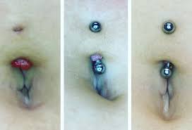 Piercing Bump 6 Ways To Get Rid Of Cartilage Or Nose Keloid Blister