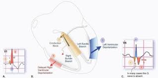 Image result for Right Bundle Branch Block