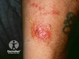 Image result for Rhus Dermatitis