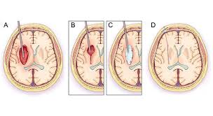 A cerebral stroke damages the brain and as we know the brain is the organ of the mental and cognitive functions, therefore a stroke alters the cognitive processes that allow the body movement. Atherosclerosis Ischemic Stroke Treatment Mount Sinai New York