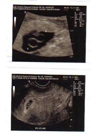 Check spelling or type a new query. 5 Weeks Momo Twins Ultrasound Scan